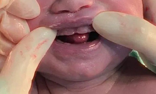 A chance da aparição de dentes natais é de 1 a cada 2.000 a 3.000 nascimentos. 