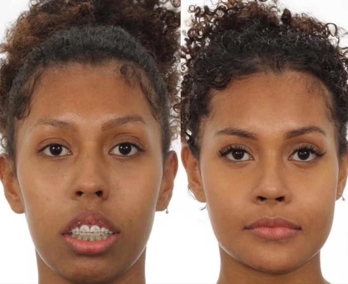 Médica responsável por cirurgia de Giovanna, do BBB 25, divulgou antes e depois da sister