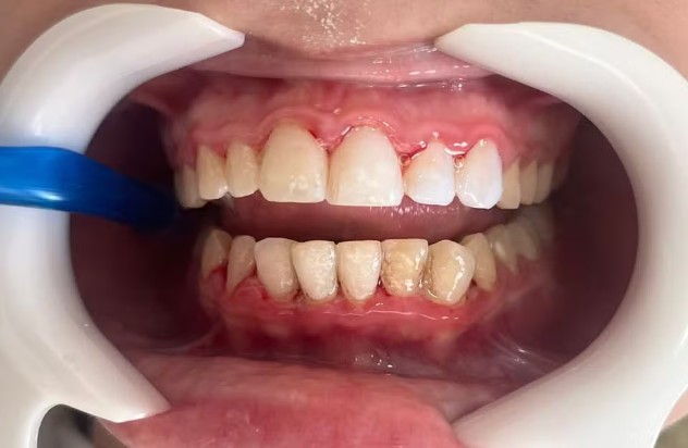 Dentes de jovem necrosaram após aplicação de lentes 