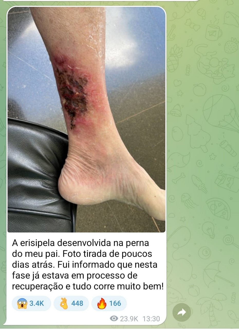 Erisipela na perna de Jair Bolsonaro