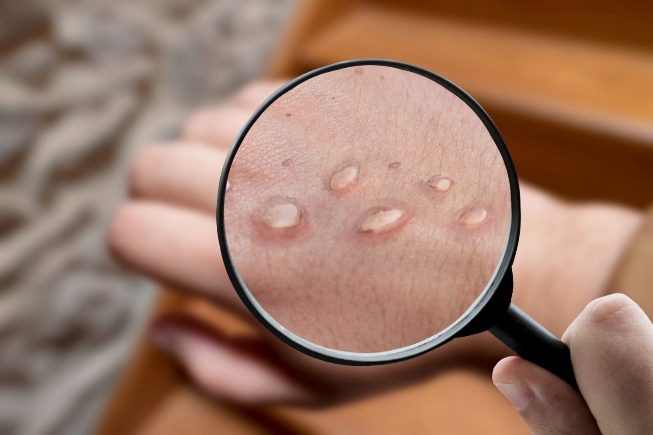 Um dos principais sintomas do mpox é a erupção cutânea