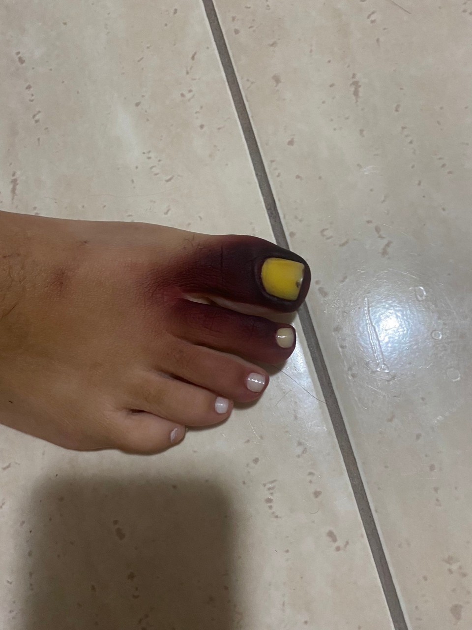 A jovem postou fotos nas redes sociais como alerta, para que as pessoas sempre verifiquem antes de colocar os calçados