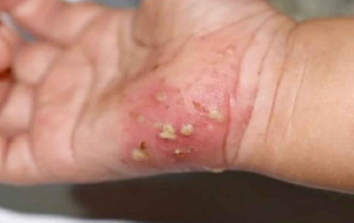 Sarna humana (escabiose) é transmitida principalmente por contato direto e prolongado pele a pele com uma pessoa infectada 