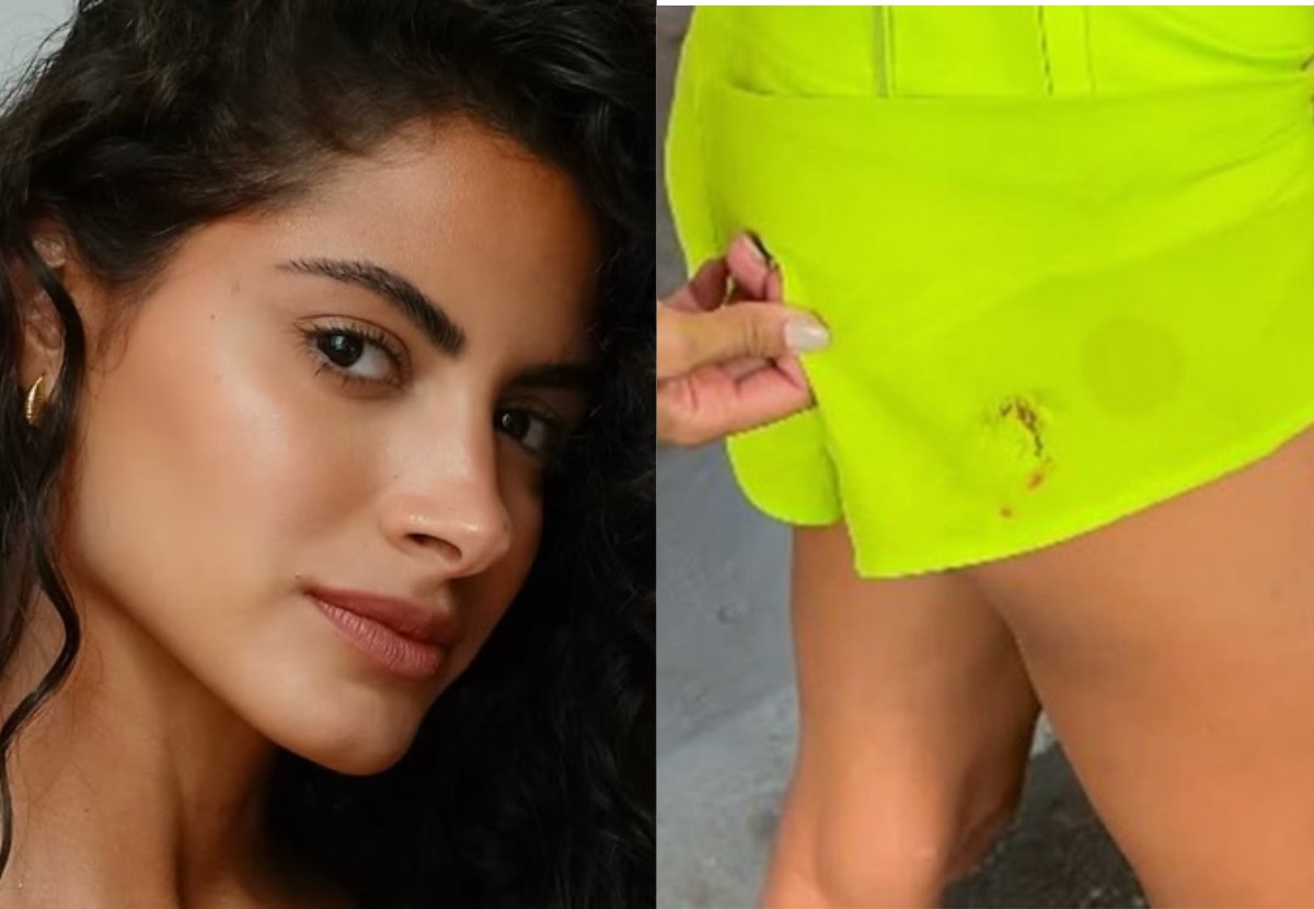 Atriz mostrou a mordida em postagem no Instagram
