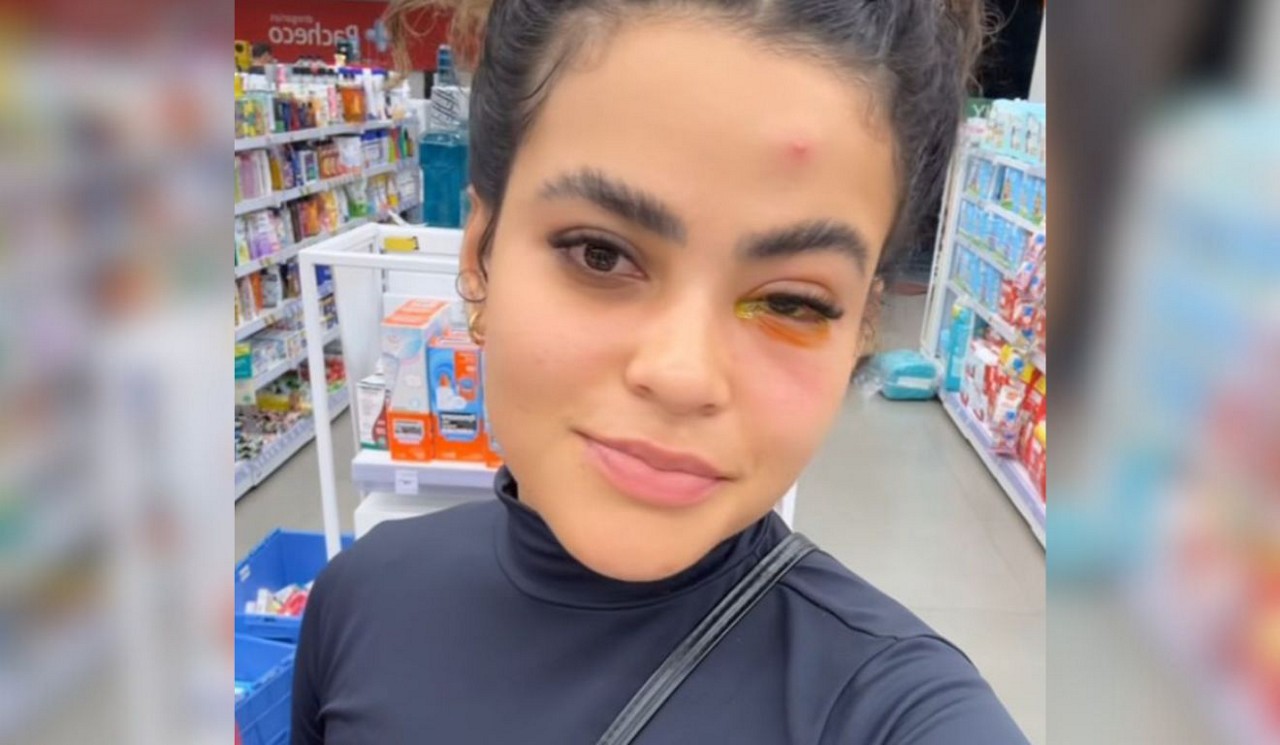 Influenciadora viraliza após ter infecção no olho causada por mosca de banheiro no ES