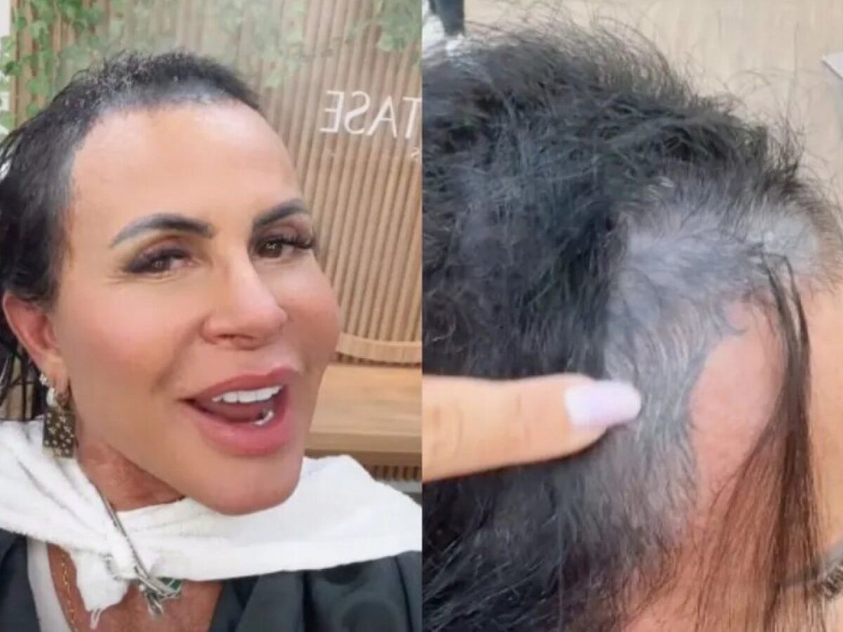 O que é alopecia? Gretchen enfrenta a doença