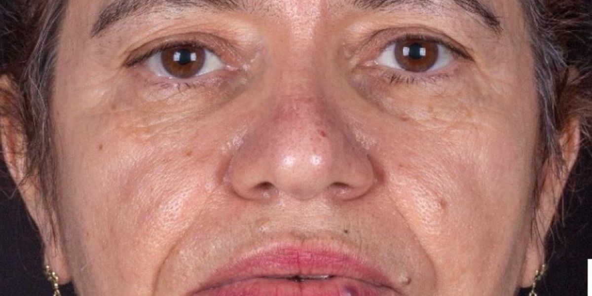 Antes e Depois 