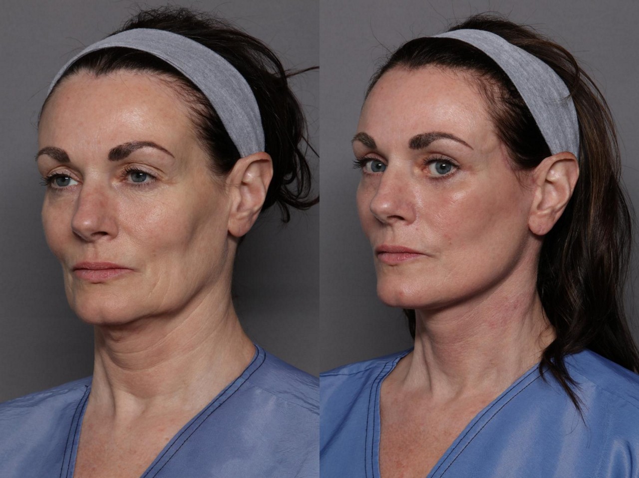 Fez um facelift ? Seu passaporte pode perder validade, alerta Polícia Federal