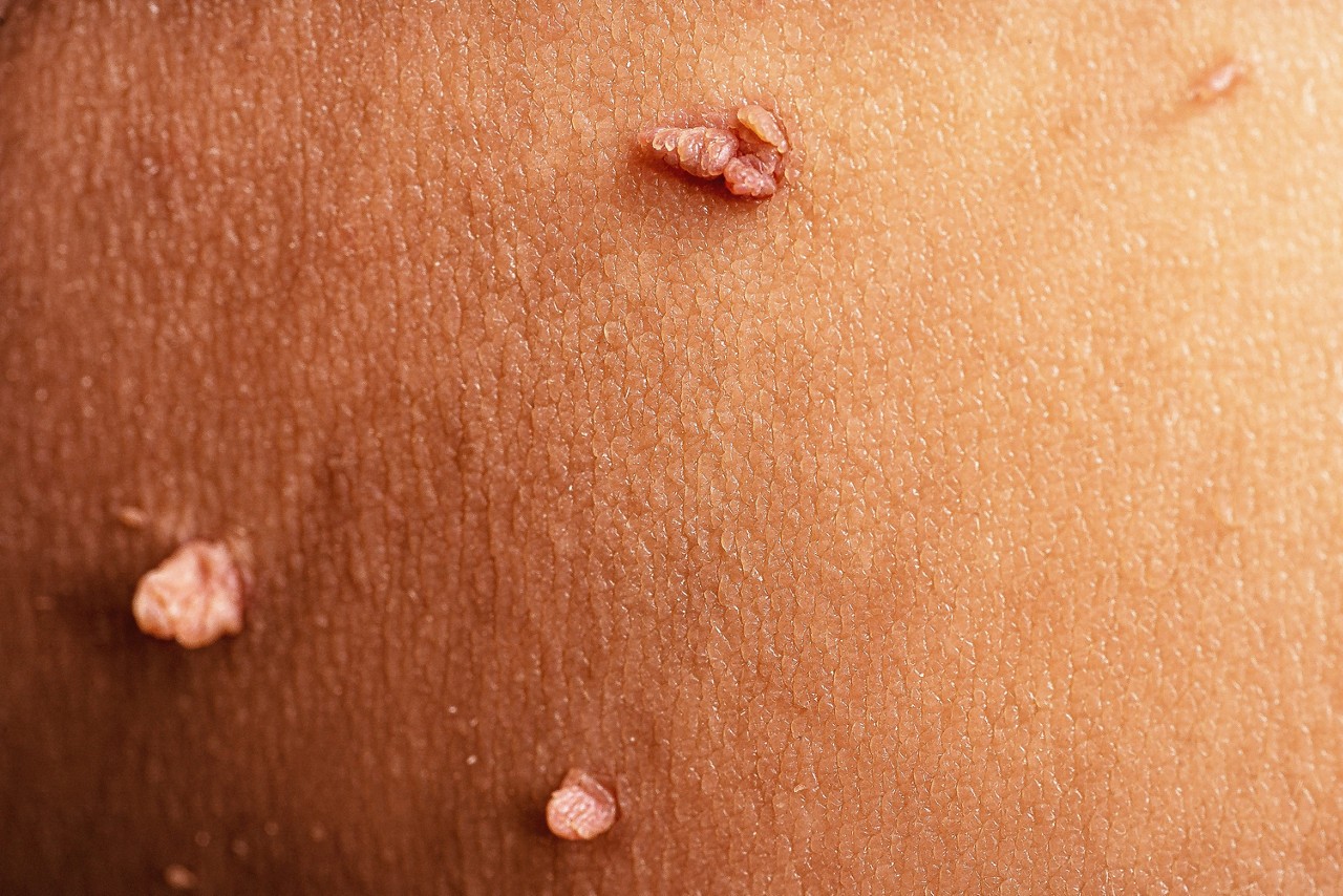 Lei reforça vacinação e atendimento pelo SUS no combate ao HPV
