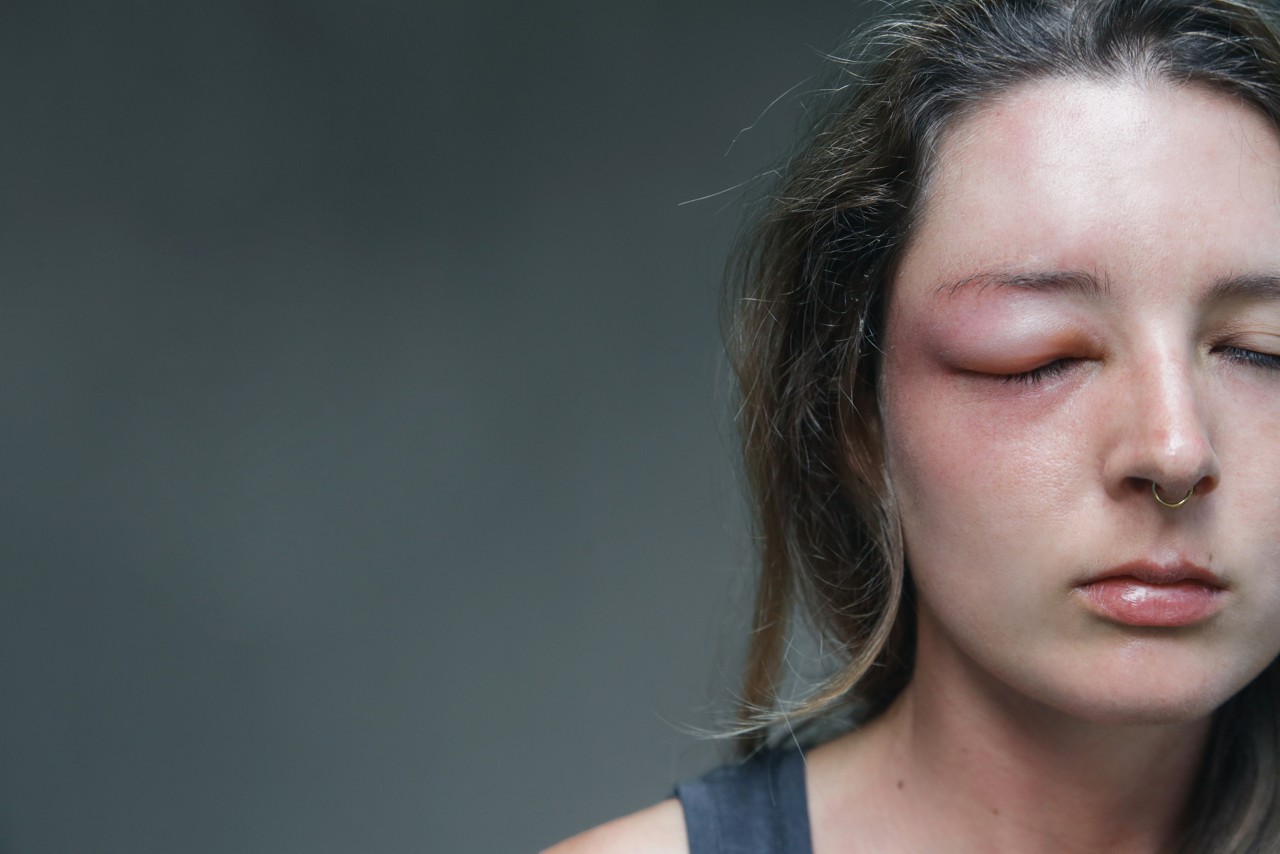 Young caucasian woman with a swollen eye from a wasp's sting. Allergy reaction on wasp bite.