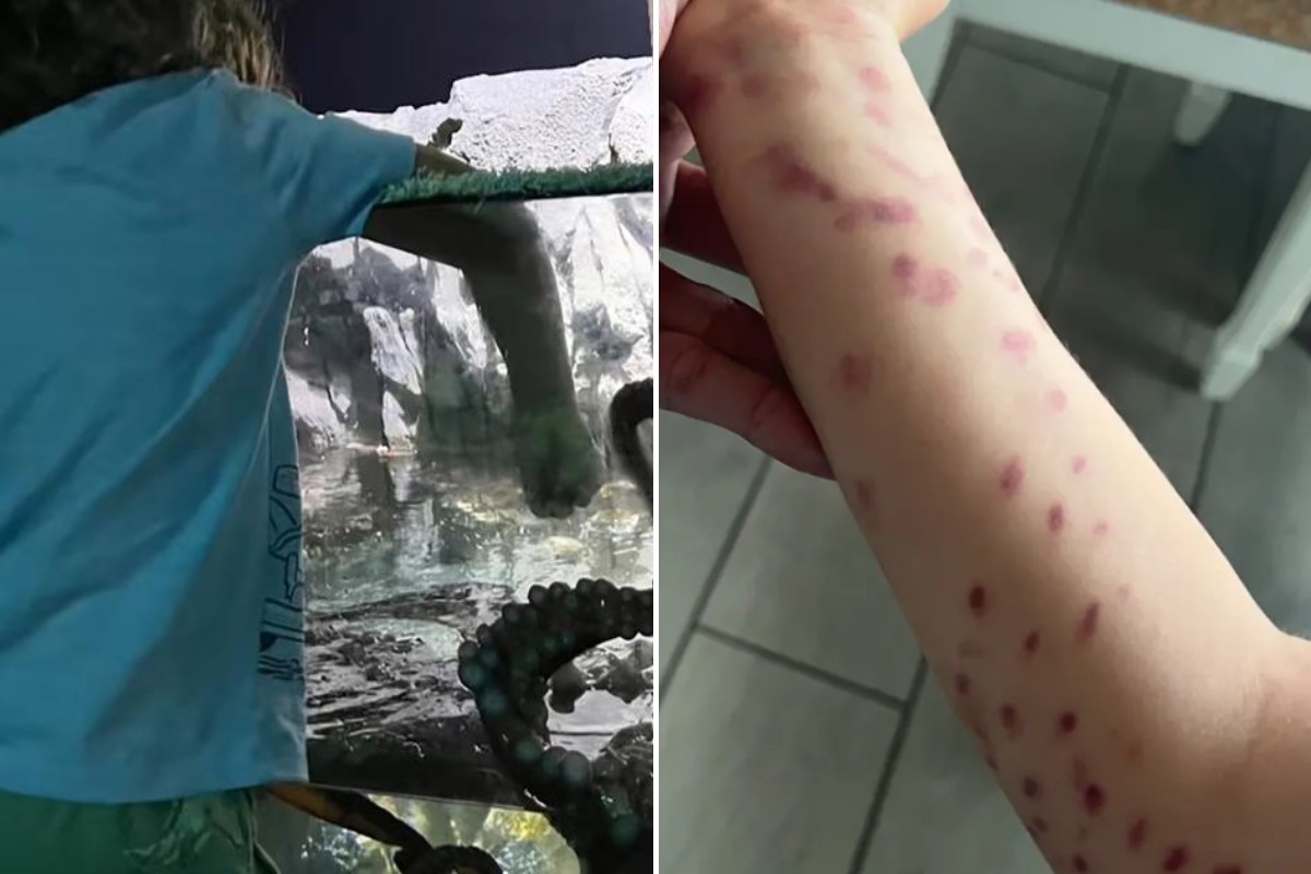 Criança foi atacada por polvo em área interativa e ficou com marcas no braço