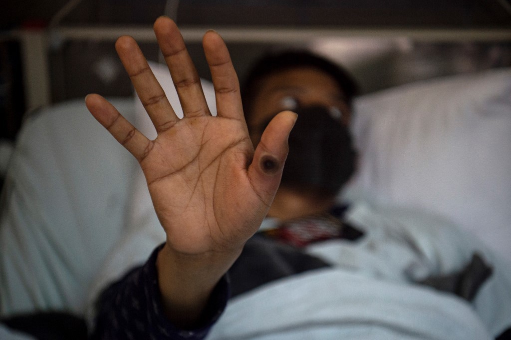 Paciente peruano mostra ferida provocada pelo vírus da mpox