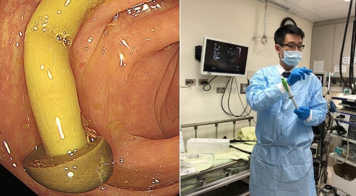 Médico descobriu cogumelo crescendo no intestino de paciente em Taiwan 
