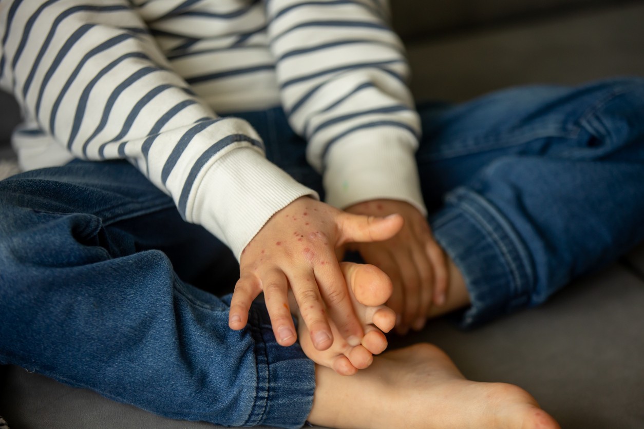 Child with skin rash, roseola, Hand-foot-and-mouth disease, child rash disease