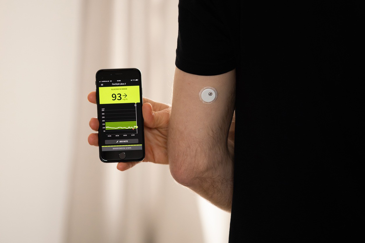 Sensor de monitoramento contínuo de glicose auxilia pacientes com diabetes tipo 1