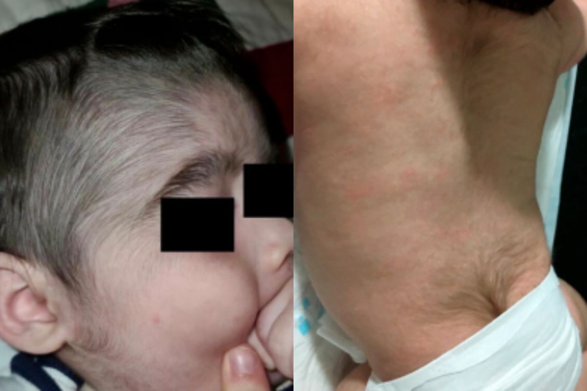 Bebês com hipertricose após contato com minoxidil