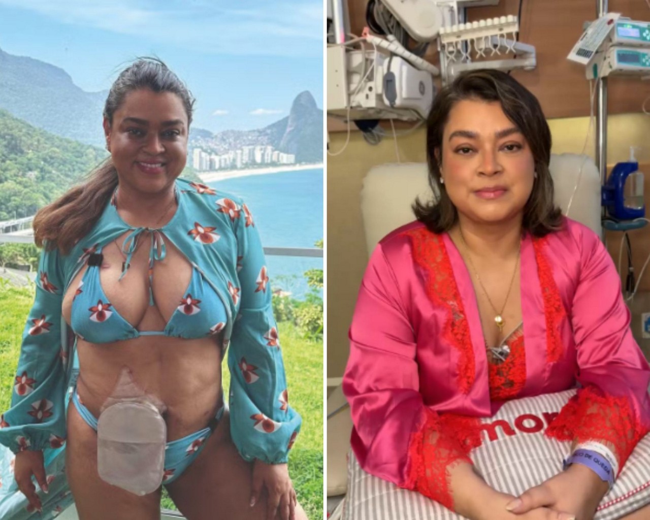 Preta Gil afirma que vai usar bolsa de colostomia de maneira definitiva