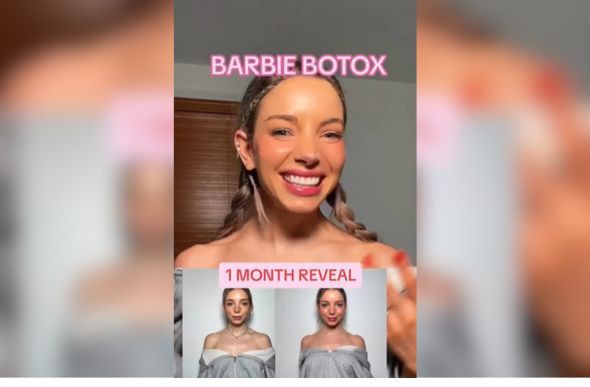Influencer norte-americana Isabelle Lux mostra antes e depois do "botox da Barbie" após um mês do procedimento