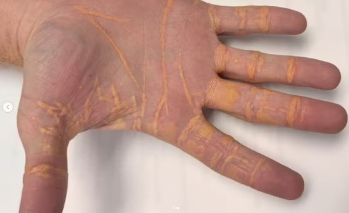Homem estava com índices tão altos de colesterol, que viu nódulos nascerem nas mãos 
