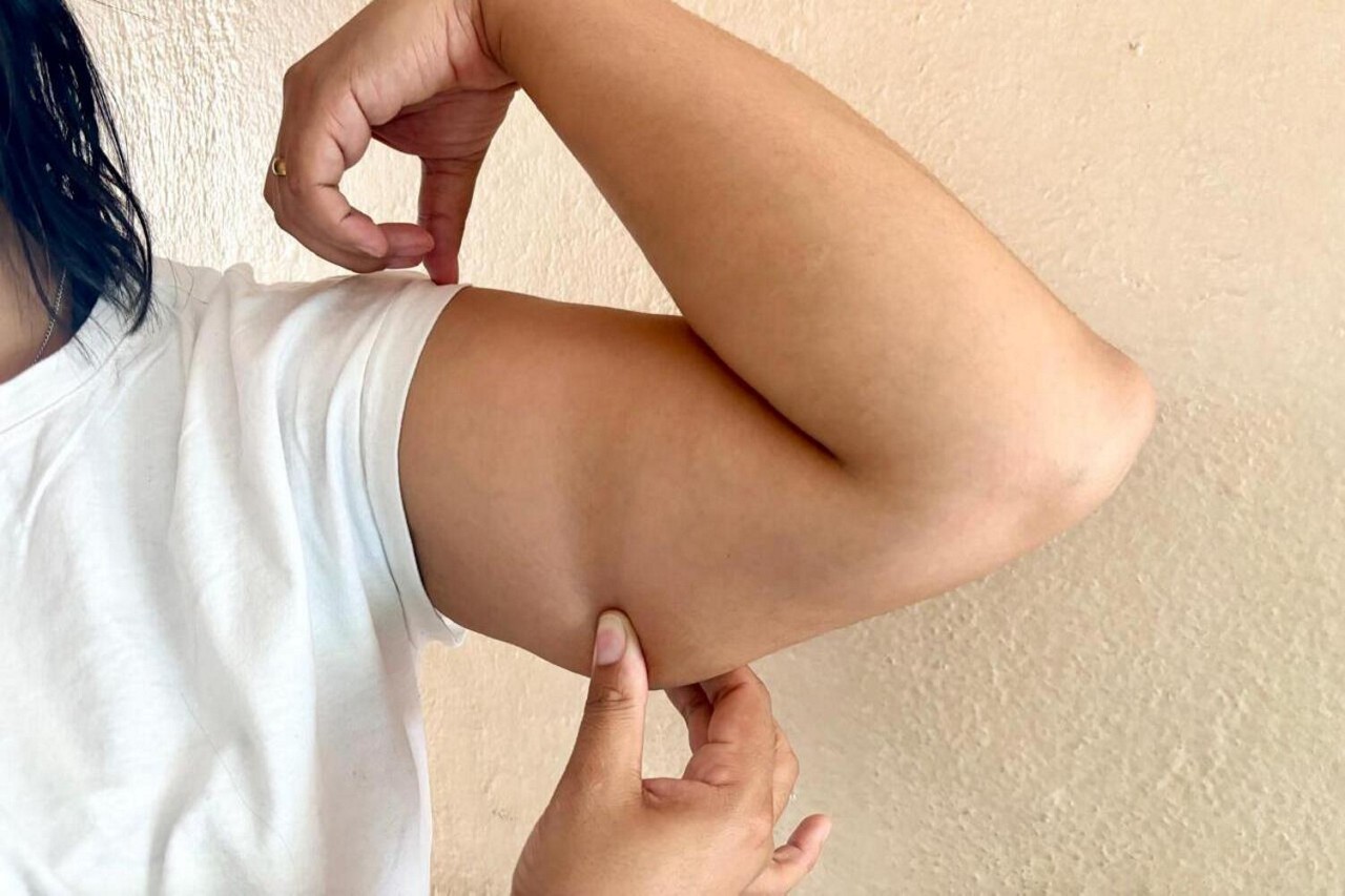 Flacidez nos braços pode ser retirada com cirurgia
