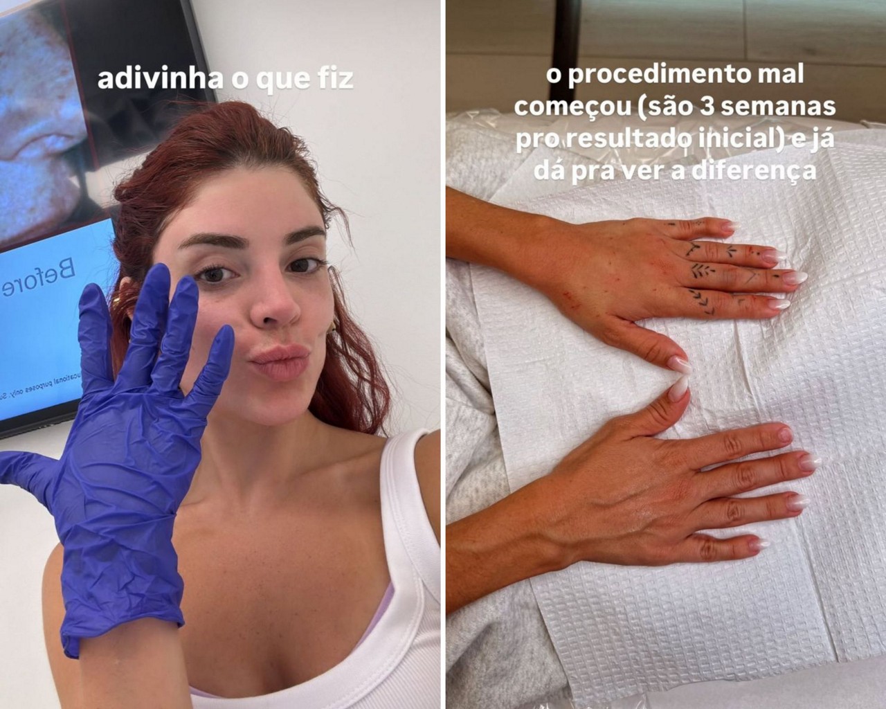 Gkay compartilhou com os seguidores o resultado da sua harmonização nas mãos