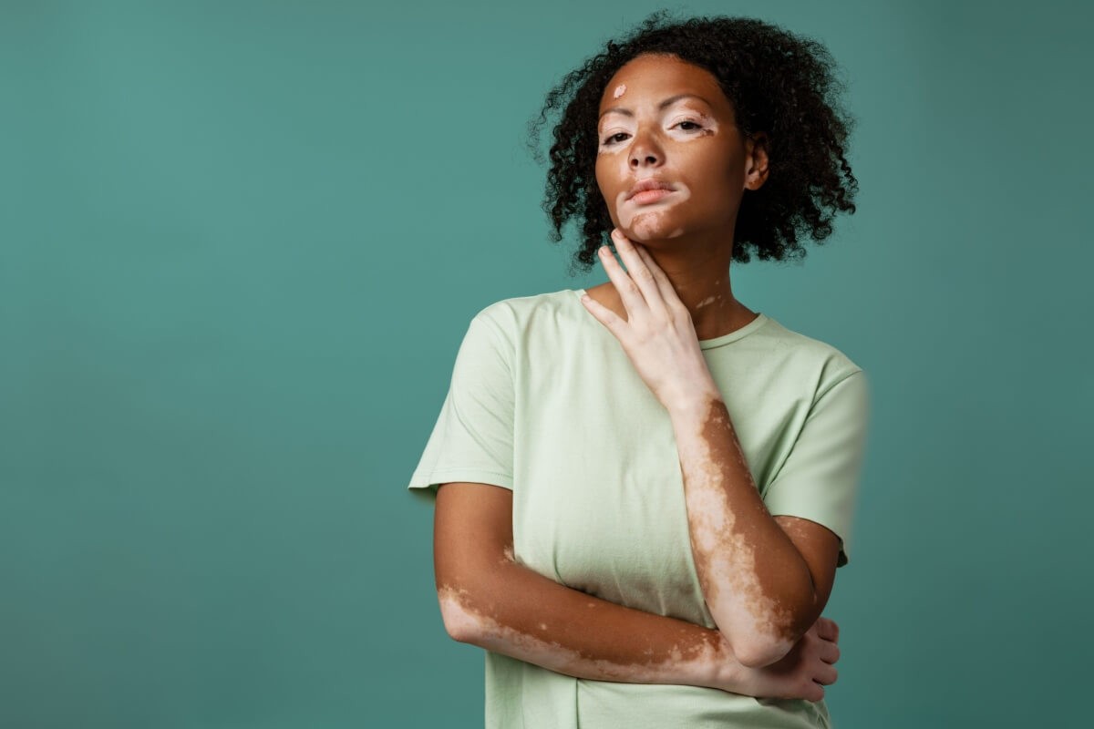 O vitiligo é caracterizado por áreas despigmentadas na pele
