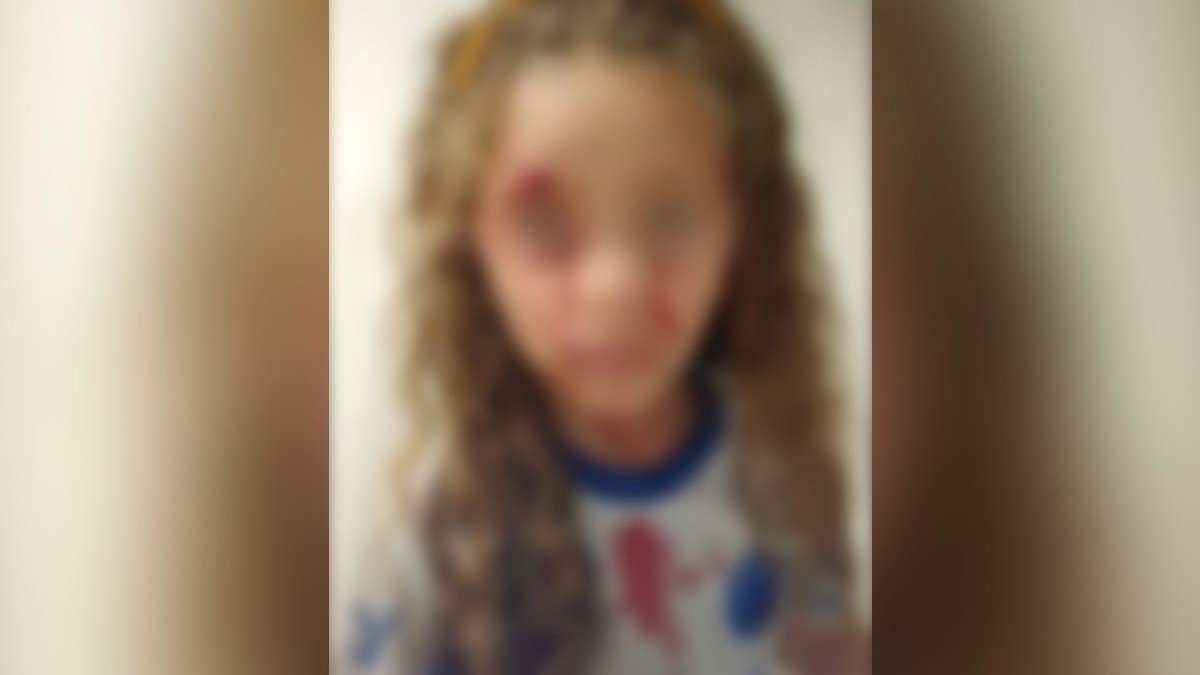 Menina ficou bastante machucada