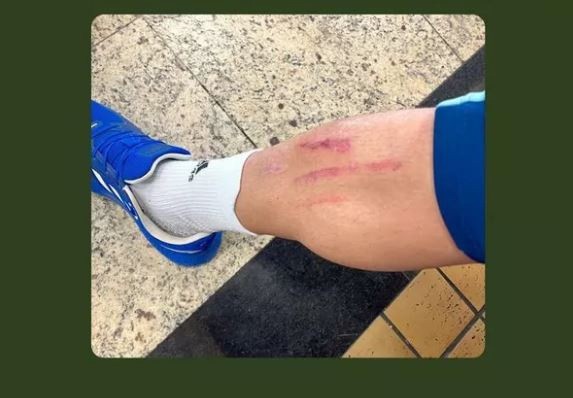 Rômulo ficou com a marca das travas de Edson na perna direita