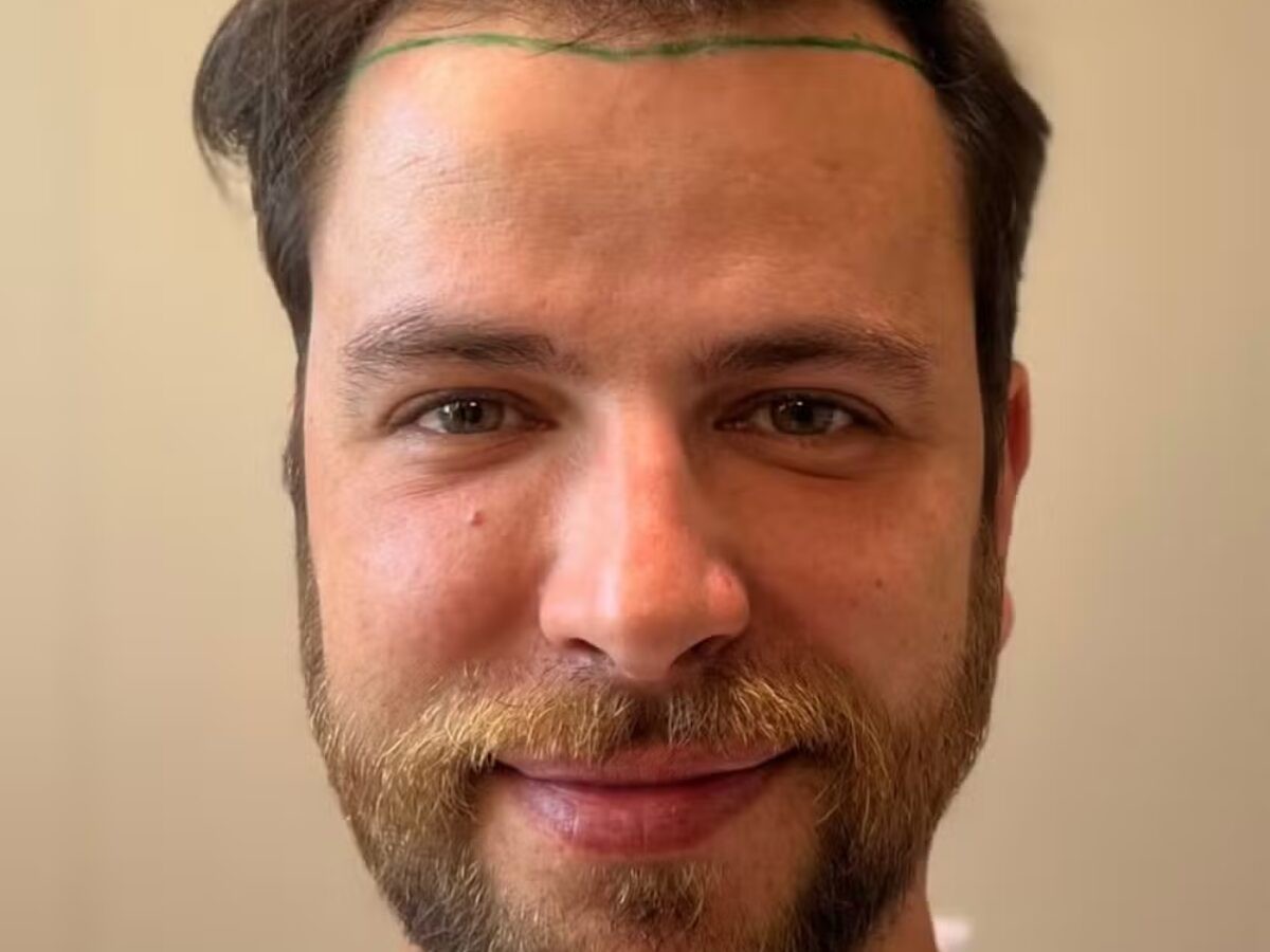Ex-BBB Gustavo Marsengo celebra resultado de transplante capilar - Reprodução / Instagram 