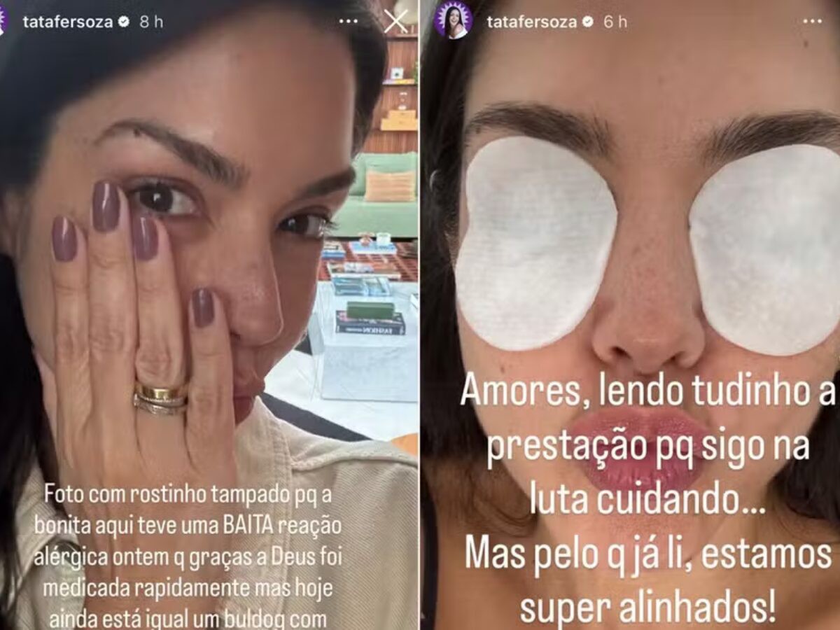 Thais Fersoza desabafa sobre reação alérgica: 'Buldogue'